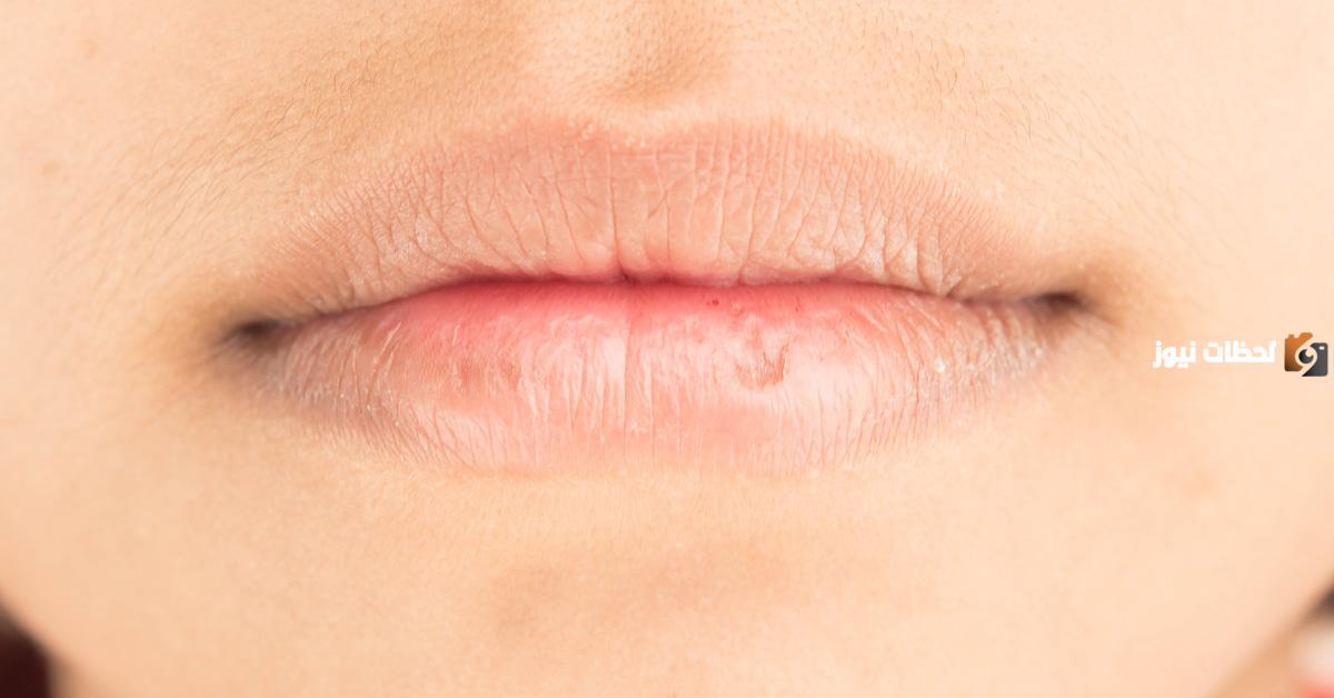 علاج الشفايف الجافة والمتشققة