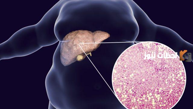 علاج دهون الكبد بالاعشاب الطبيعية