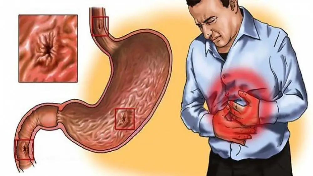 علاج جرثومة المعدة بالأعشاب