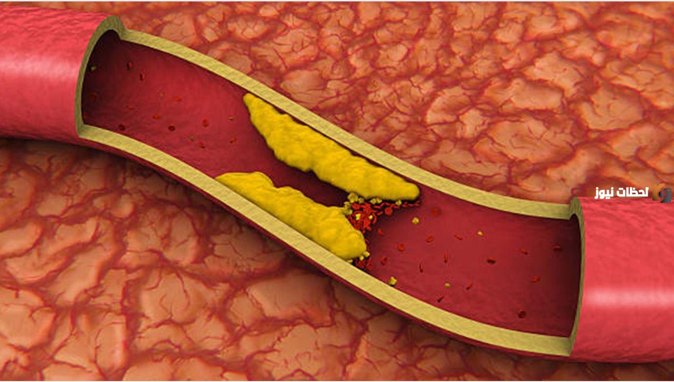 علاج الكوليسترول بالأعشاب الطبية