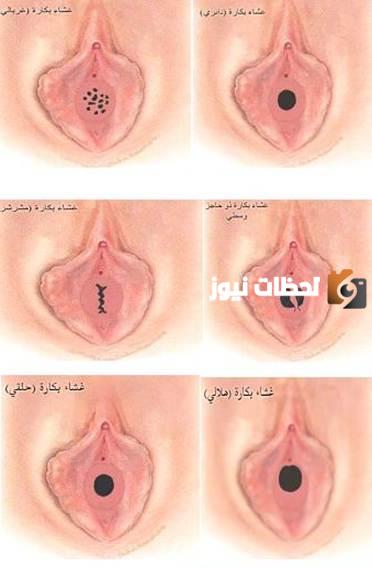 كيف شكل غشاء البكارة السليم