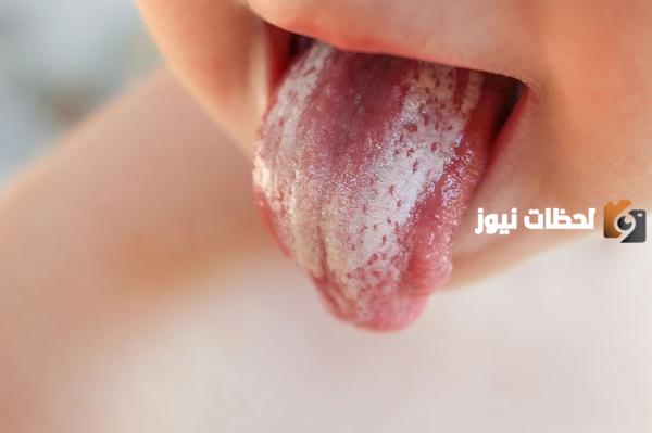 علاج فطريات اللسان والحلق المزمنة بالأعشاب الطبية منزليا