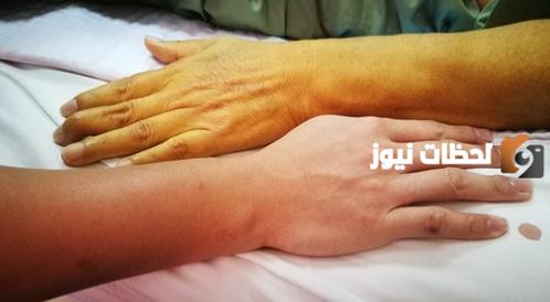 متى تكون نسبة الصفراء خطيرة
