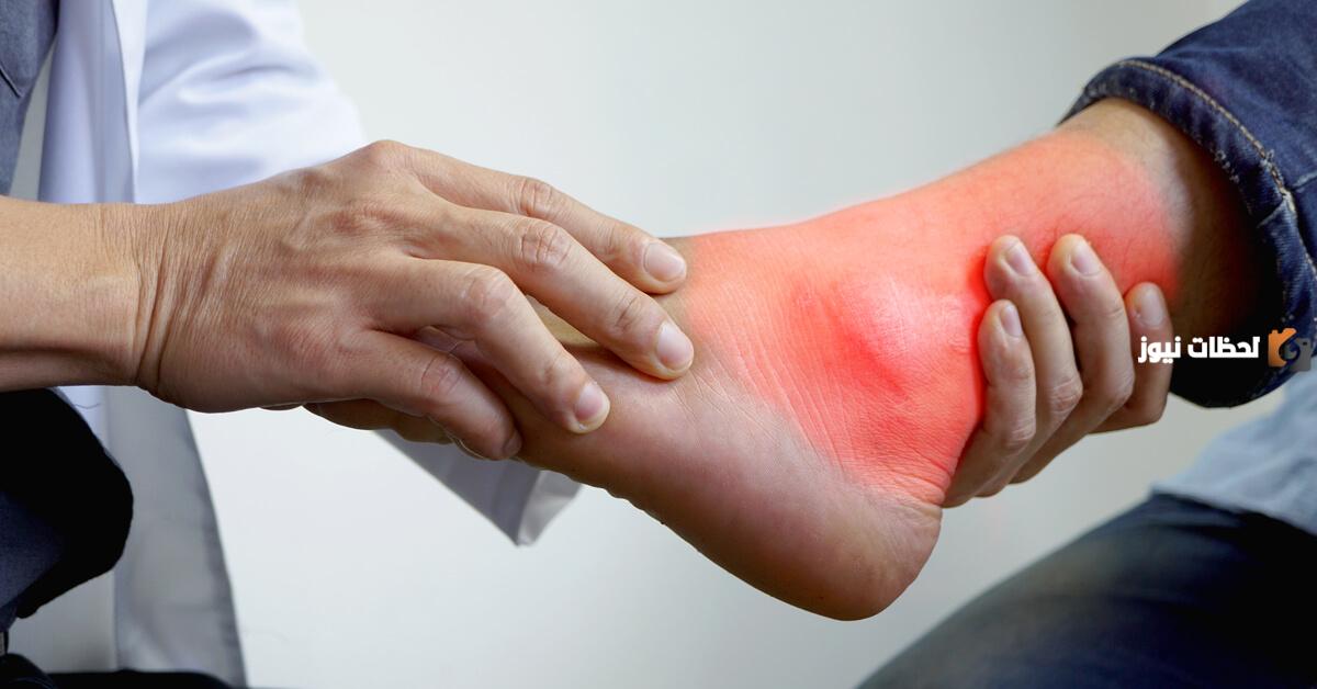 علاج مرض النقرس نهائيا وطرق الوقاية في المنزل