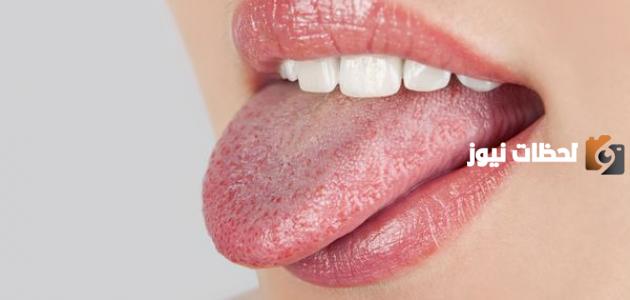 علاج فطريات اللسان والحلق المزمنة بالأعشاب الطبية منزليا