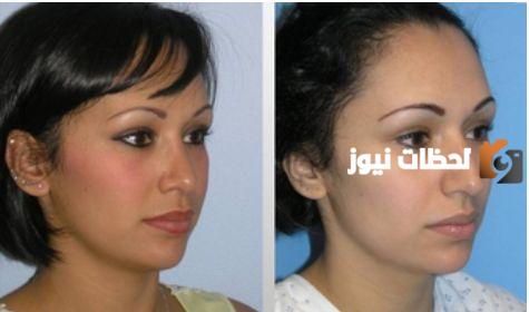 تكلفة عملية تجميل الأنف في مستشفى الحبيب السعودي