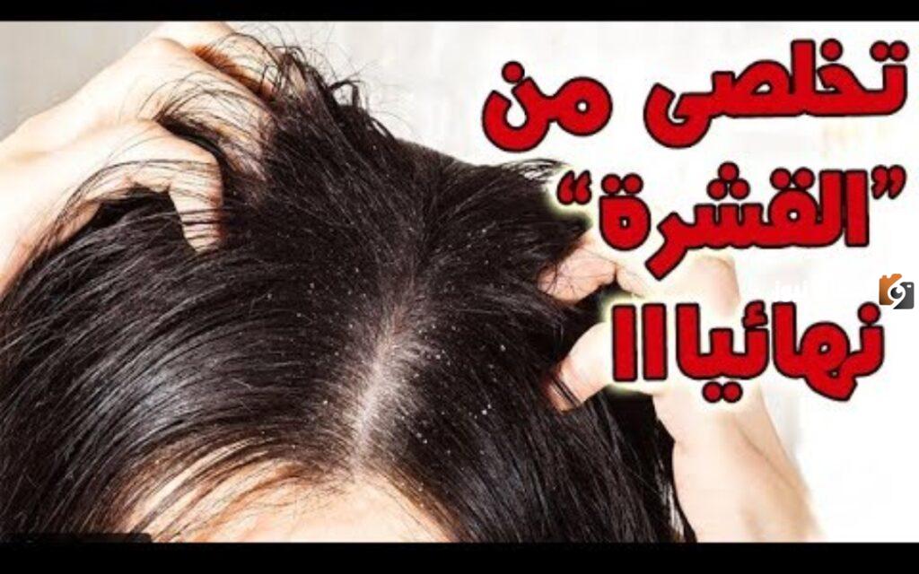 أفضل خلطات للتخلص من قشرة الشعر 4 خلطات سهلة