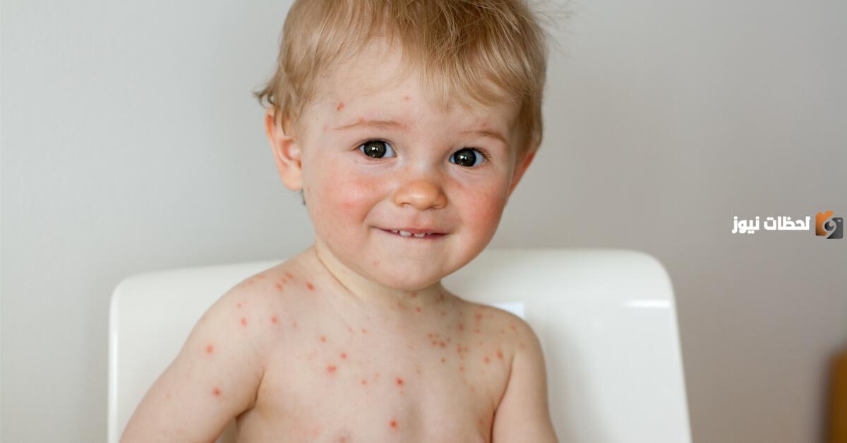 طريقة علاج مرض الجدري عند الاطفال بسرعة