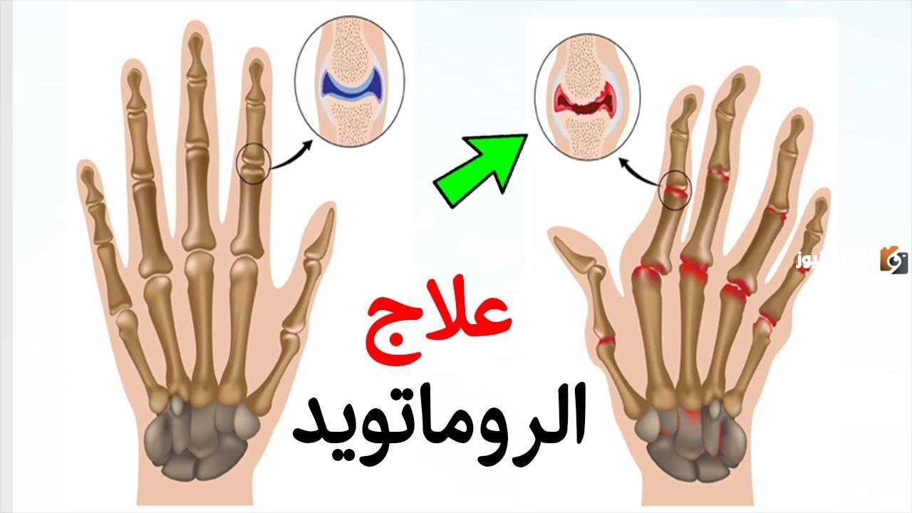 علاج الروماتويد بالاعشاب وقائمة الممنوعات والمسموحات لمرضى الروماتويد