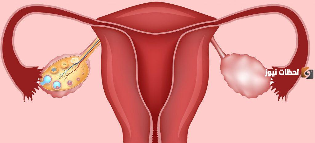 علاج تكيس المبايض بالاعشاب للدكتور جابر القحطاني