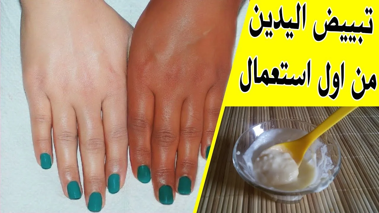 كريم تبييض طبي سريع المفعول لليدين