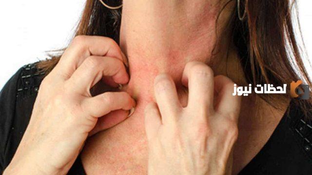 كيف اتخلص من التينيا نهائيا؟ علاج مرض التينيا في الجسم