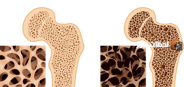 كيف اتخلص من هشاشة العظام نهائيا؟ علاج هشاشة العظام بالاعشاب كيف اتخلص من هشاشة العظام نهائيا؟ علاج هشاشة العظام بالاعشاب