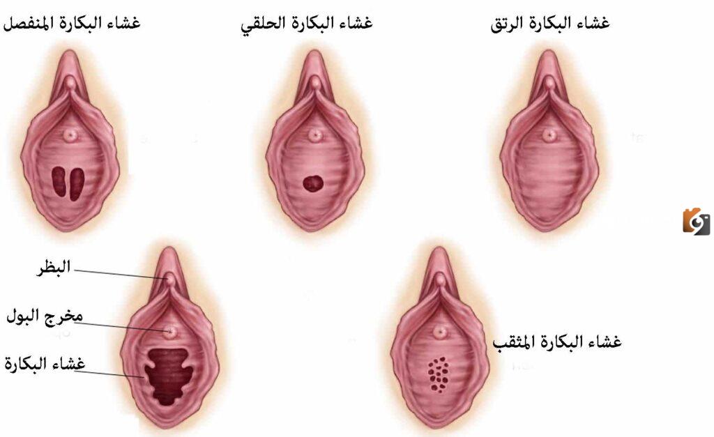 كيف شكل غشاء البكارة السليم