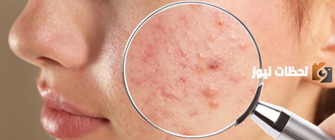 ما هو علاج ندبات حب الشباب بخلطات طبيعية