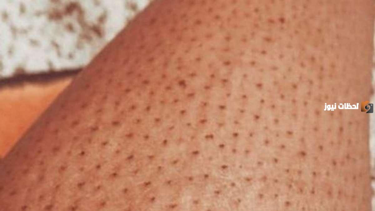 ما هو علاج نمو الشعر تحت الجلد فى الساقين