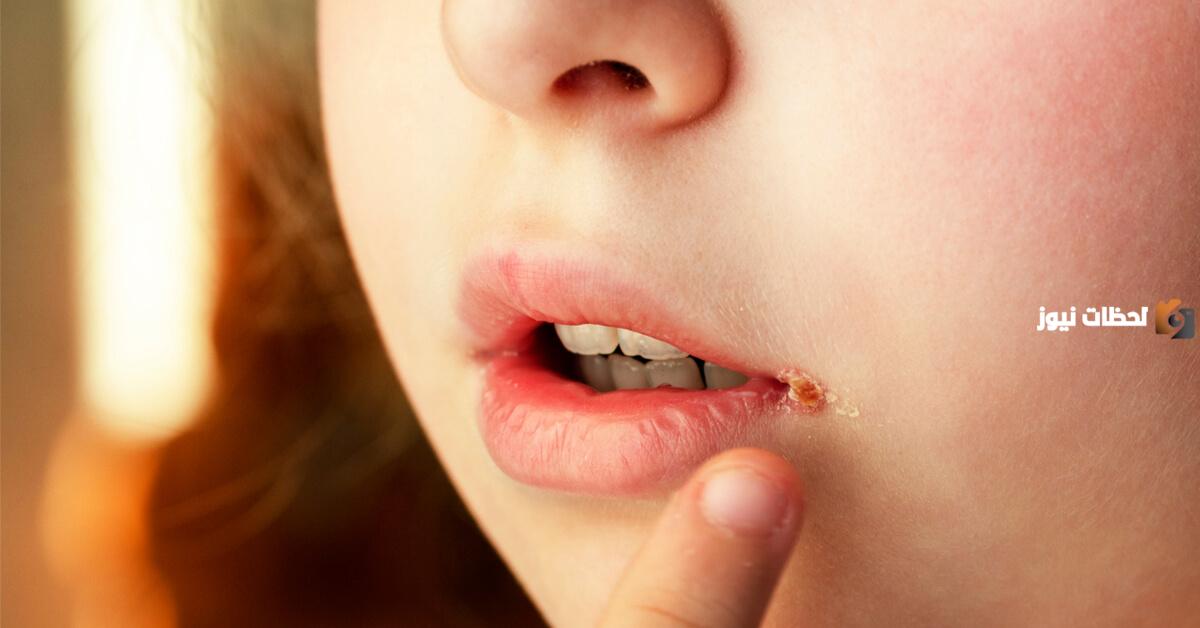 ما هي الفطريات في الفم وما أنواعها