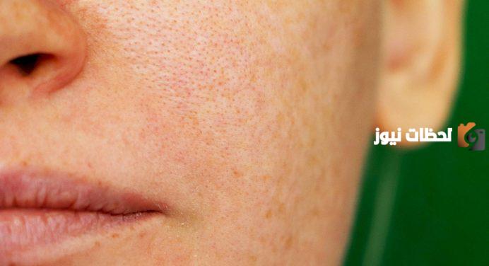 ما هي طرق علاج المسامات المسدودة على الذقن والأنف