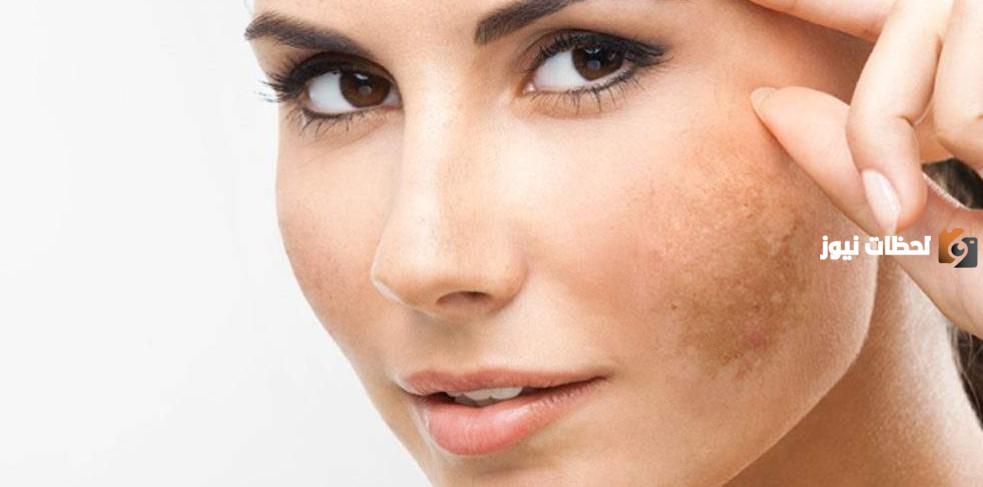 وصفات لعلاج الكلف والنمش