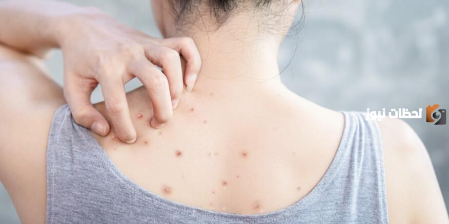 وصفات وطرق علاج حبوب الظهر بالأعشاب والزيوت الطبيعية