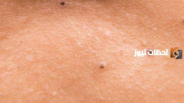  أسباب ظهور نقط سوداء على الجلد