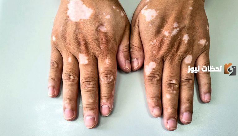 متى اليوم العالمي للبهاق