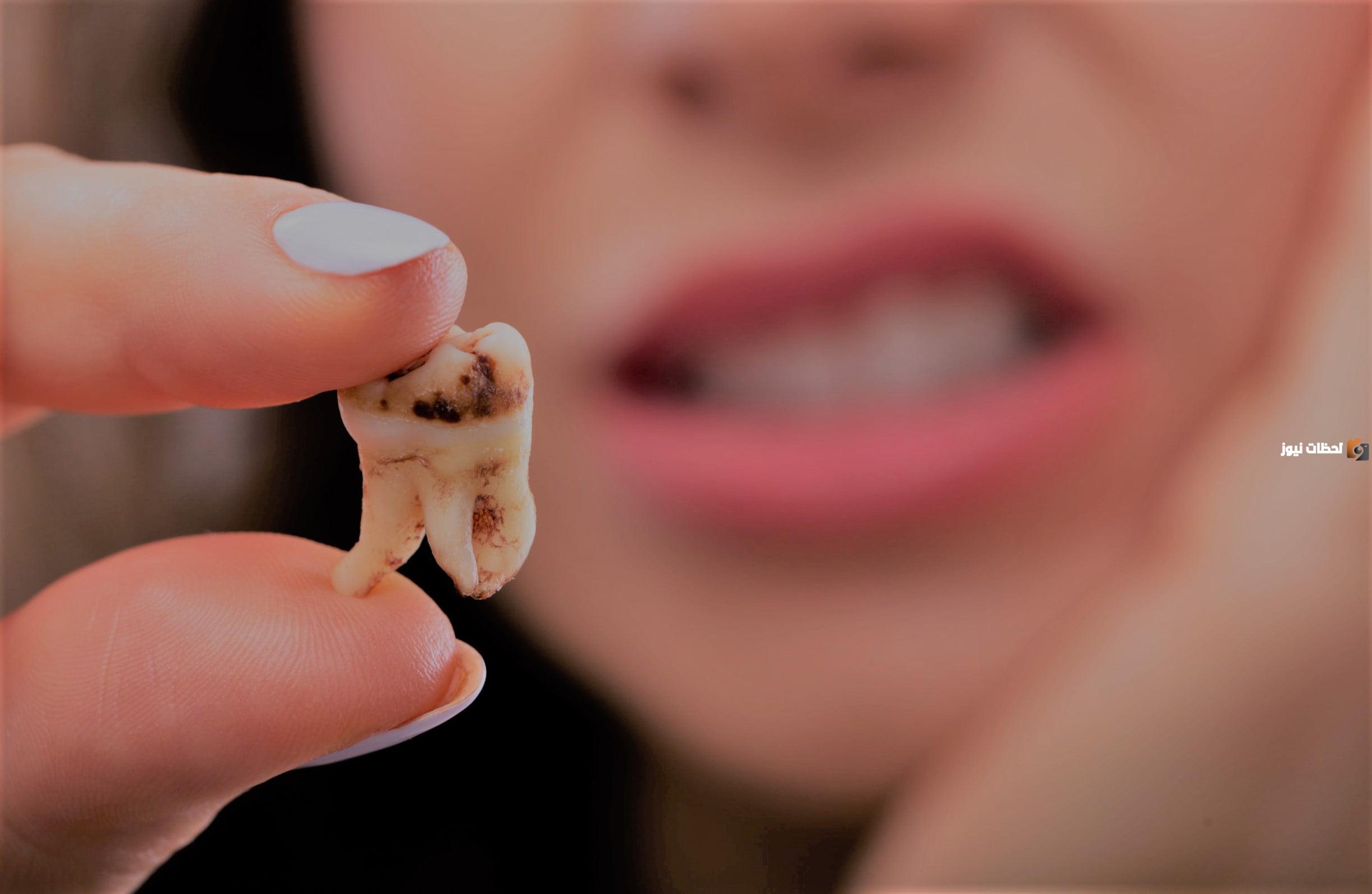 هل يمكن إزالة التسوس من الأسنان؟! أفضل طرق علاج تسوس الأسنان