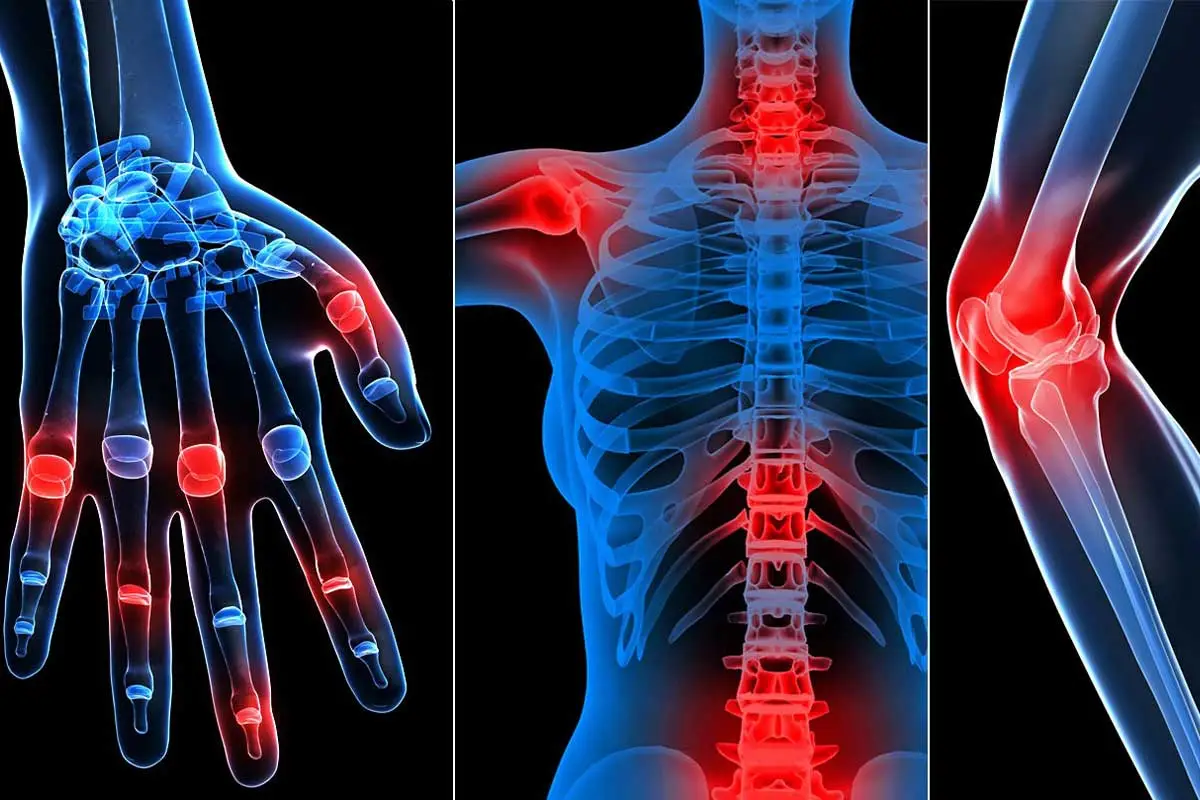 ما هو الروماتيزم 