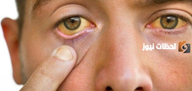 اصفرار العين