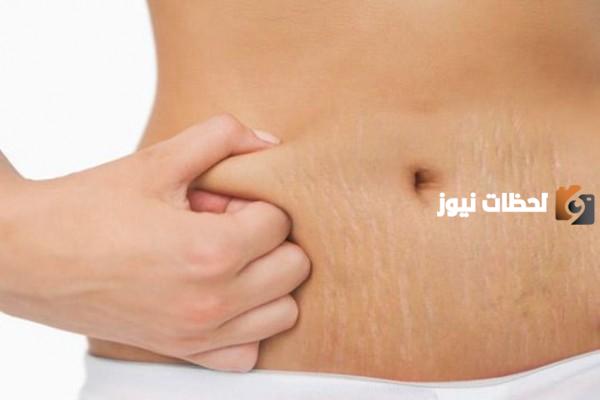 علاج سيلوليت البطن بعد الولادة