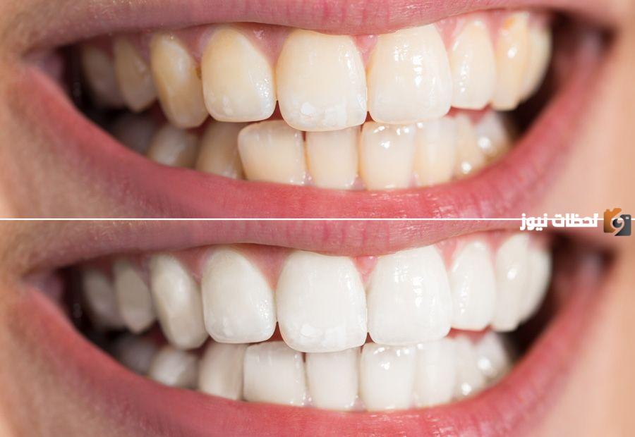 تبيض الأسنان في المنزل