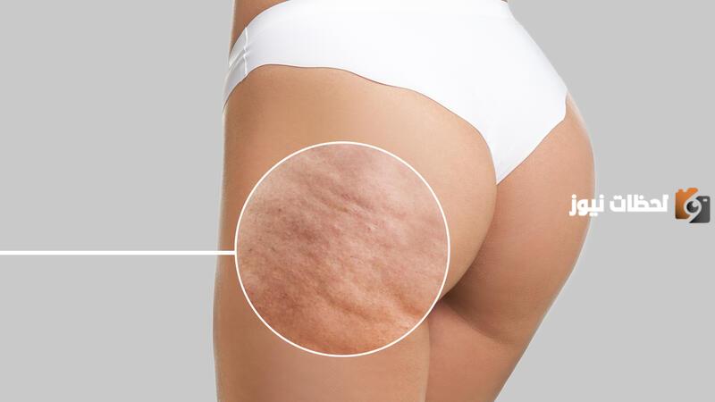 علاج السيلوليت