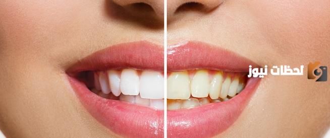 تبيض الأسنان في المنزل