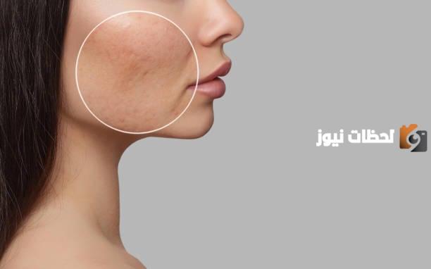 تعرف على طرق إزالة وعلاج حفر الوجة والبشرة طبيعيا