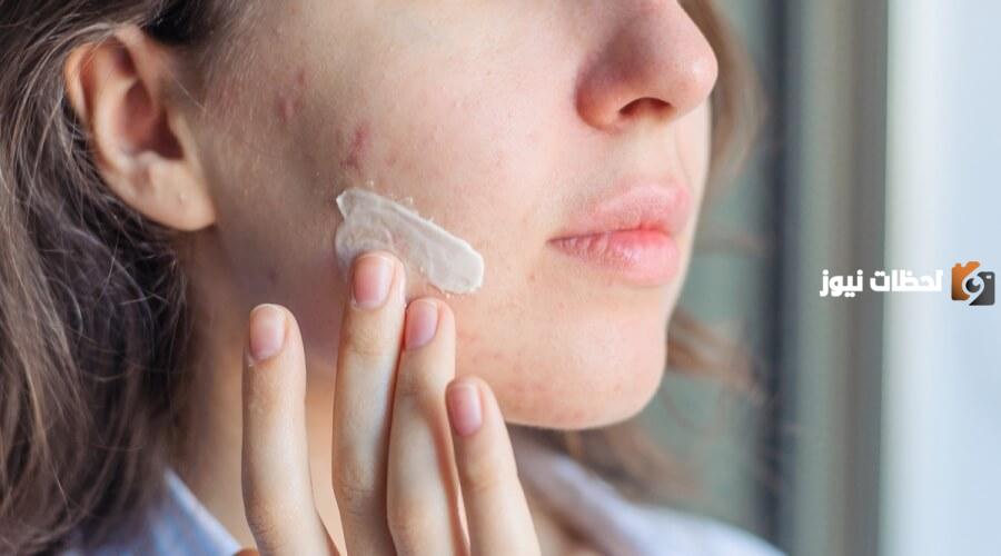 طرق علاج حب الشباب طبيعية وسريعة نهائياً من المنزل