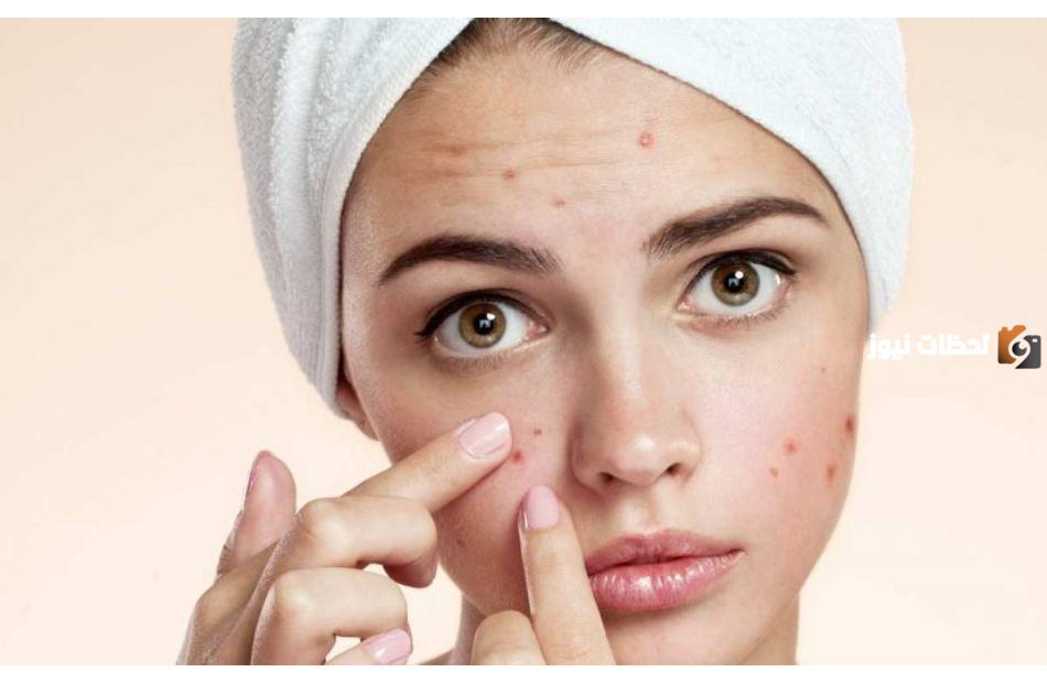 هذه أفضل كريمات علاج آثار حب الشباب وخلطات لحب الشباب