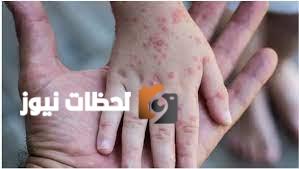 الفلبين تسجل عشرة حالات جديدة من جدري القرود بشكل رسمي
