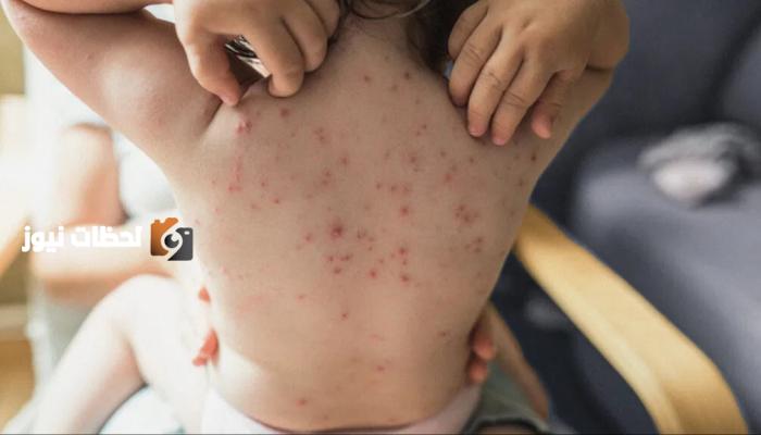 تسجيل أكثر من 3000 حالة إصابة بجدري القرود في سيراليون