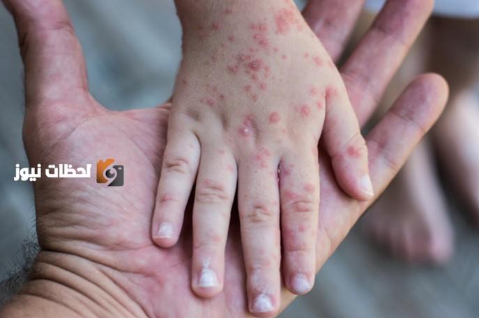 تكساس تسجل ست حالات جديدة حصبة ليصل الاجمالي الى سبعمئة وثمانية وعشرين