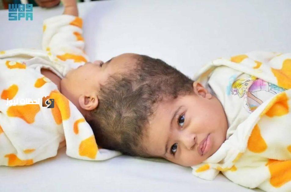 عملية جراحية ناجحة لفصل التوأم الإريتري «أسماء وسمية» بعد 15 ساعة من العناء
