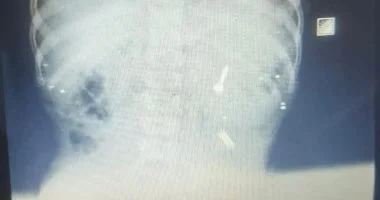 إنقاذ طفل ابتلع مسمارًا في مجمع الشفاء الطبي ببورسعيد