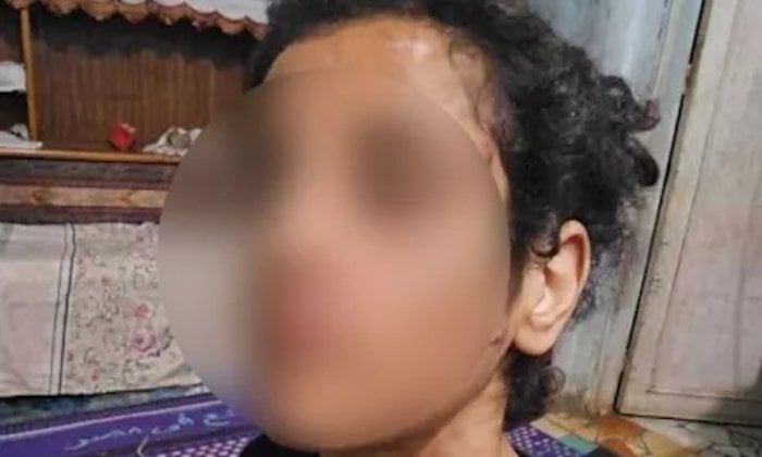 القبض على أب وزوجته لاتهامها بتعذيب ابنته بالمنوفية