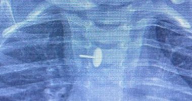 فريق جراحة بالقليوبية يزيل دبوسًا من مرئ طفلة عمره ستة أشهر