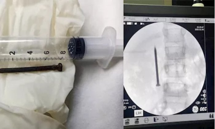 فريق طبي بجامعة المنوفية ينجح في استخراج مسمار حاد من أمعاء طفلة