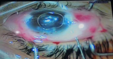 فريق طبي بمستشفى المنصورة ينقذ سيدة من فقدان البصر بتدخل ناجح