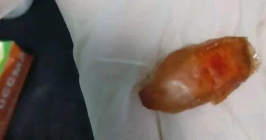 مستشفى بالشرقية ينقذ رضيعا ابتلع بلحة وتوقف قلبه عن العمل.