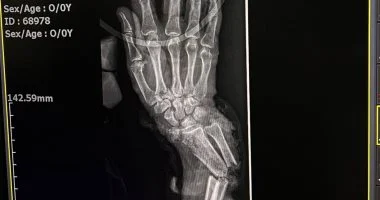 نجاح طبي بمستشفى سوهاج الجامعي ينقذ حالتين من البتر المؤكد