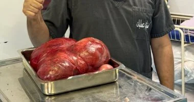 نجاح مستشفى المنصورة التخصصي في إزالة ورم 8 كيلوغرامات من سيدة